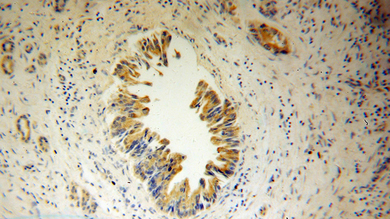 Immunohistochemical of paraffin-embedded human pancreas cancer using Catalog No:115267(SHC3 antibody) at dilution of 1:50 (under 10x lens)