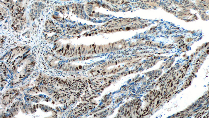 Immunohistochemistry of paraffin-embedded human colon cancer tissue slide using Catalog No:112113(KPNA2 Antibody) at dilution of 1:200 (under 10x lens). heat mediated antigen retrieved with Tris-EDTA buffer(pH9).
