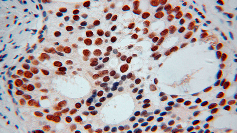 Immunohistochemical of paraffin-embedded human gliomas using Catalog No:112038(KHDRBS3 antibody) at dilution of 1:100 (under 40x lens)