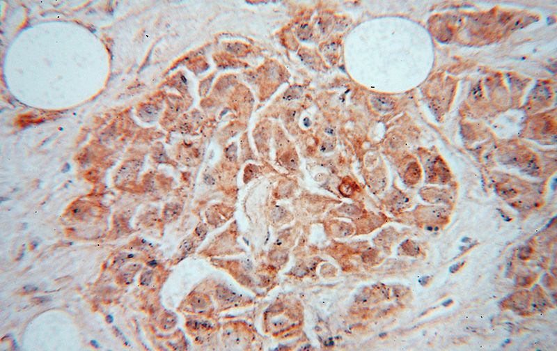 Immunohistochemical of paraffin-embedded human breast cancer using Catalog No:108824(CALM3 antibody) at dilution of 1:50 (under 40x lens)