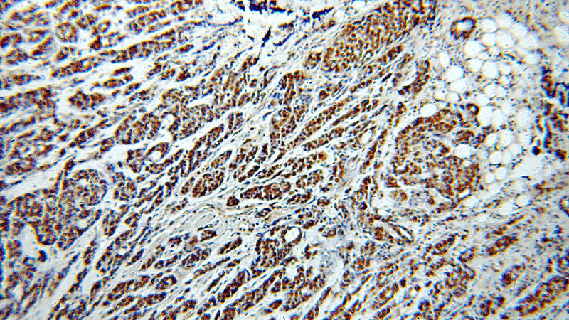 Immunohistochemical of paraffin-embedded human cervical cancer using Catalog No:114588(RBBP7 antibody) at dilution of 1:50 (under 10x lens)