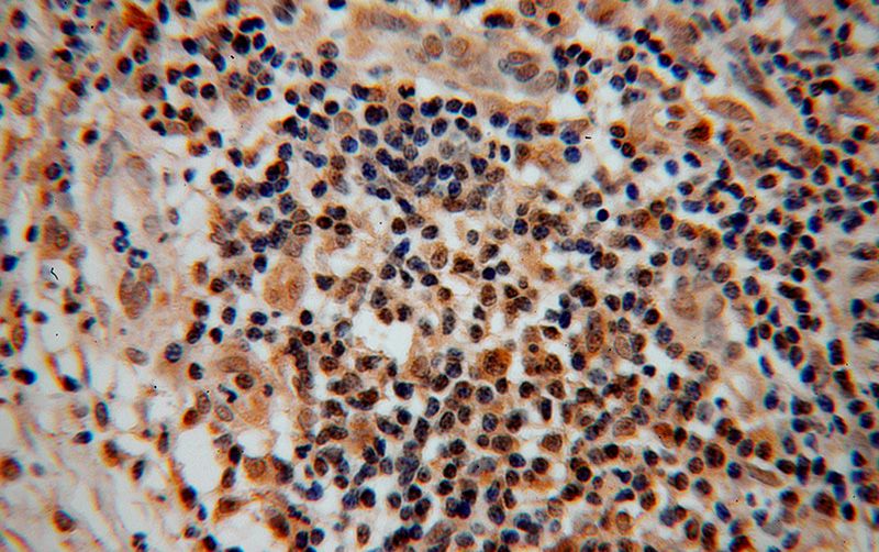 Immunohistochemical of paraffin-embedded human cervical cancer using Catalog No:109093(CDC16 antibody) at dilution of 1:50 (under 40x lens)