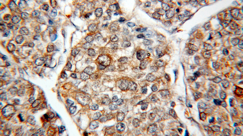 Immunohistochemical of paraffin-embedded human liver cancer using Catalog No:111261(C4orf15 antibody) at dilution of 1:100 (under 40x lens)
