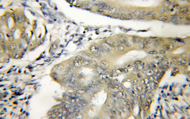Immunohistochemical of paraffin-embedded human colon cancer using Catalog No:110097(DNAJB6 antibody) at dilution of 1:100 (under 10x lens)