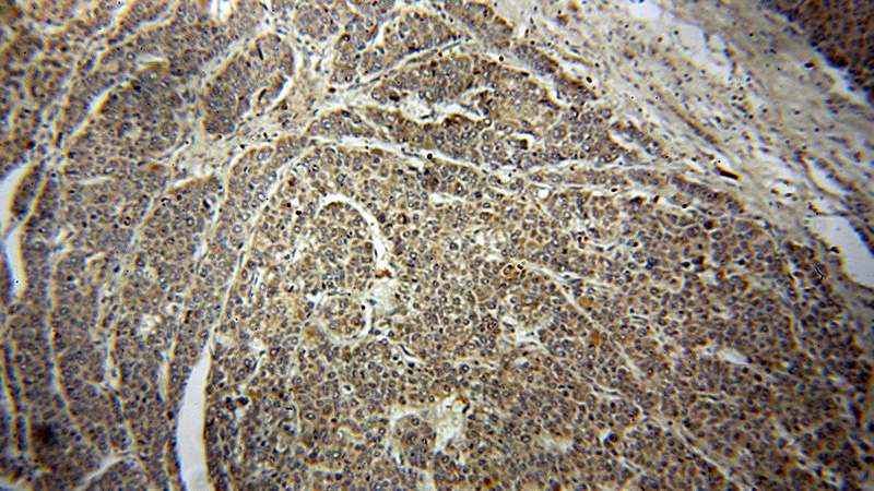 Immunohistochemical of paraffin-embedded human liver cancer using Catalog No:111677(IGF1B-Specific antibody) at dilution of 1:50 (under 10x lens)