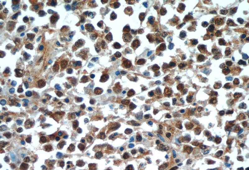 Immunohistochemical of paraffin-embedded human lymphoma using Catalog No:109418(MYC antibody) at dilution of 1:50 (under 40x lens)