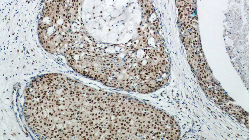 Immunohistochemical of paraffin-embedded human breast cancer using Catalog No:110804(GABPA antibody) at dilution of 1:50 (under 10x lens)