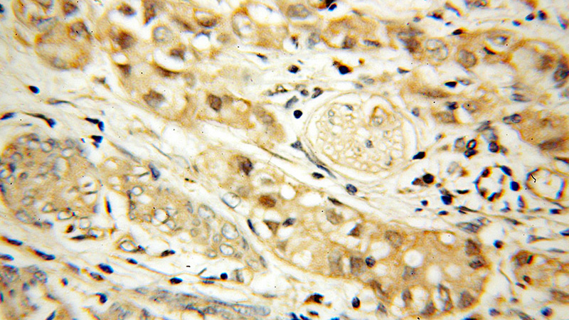 Immunohistochemical of paraffin-embedded human endometrial cancer using Catalog No:109165(CDK6 antibody) at dilution of 1:50 (under 40x lens)