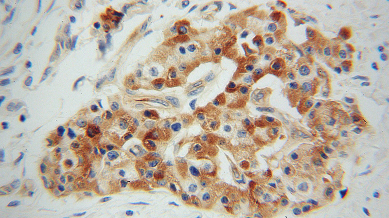 Immunohistochemical of paraffin-embedded human pancreas cancer using Catalog No:116809(VWA1 antibody) at dilution of 1:50 (under 40x lens)