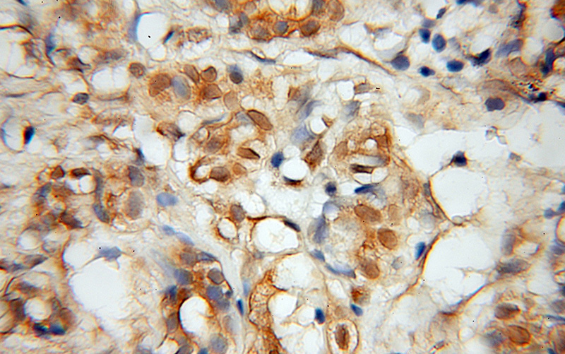 Immunohistochemical of paraffin-embedded human pancreas cancer using Catalog No:112622(MINA antibody) at dilution of 1:50 (under 10x lens)