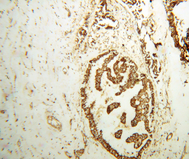 Immunohistochemical of paraffin-embedded human breast cancer using Catalog No:111220(GRP75 antibody) at dilution of 1:100 (under 10x lens)