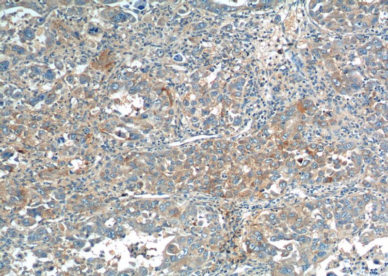 Immunohistochemistry of paraffin-embedded human liver cancer tissue slide using Catalog No:112293(Loc55908 Antibody) at dilution of 1:200 (under 10x lens).