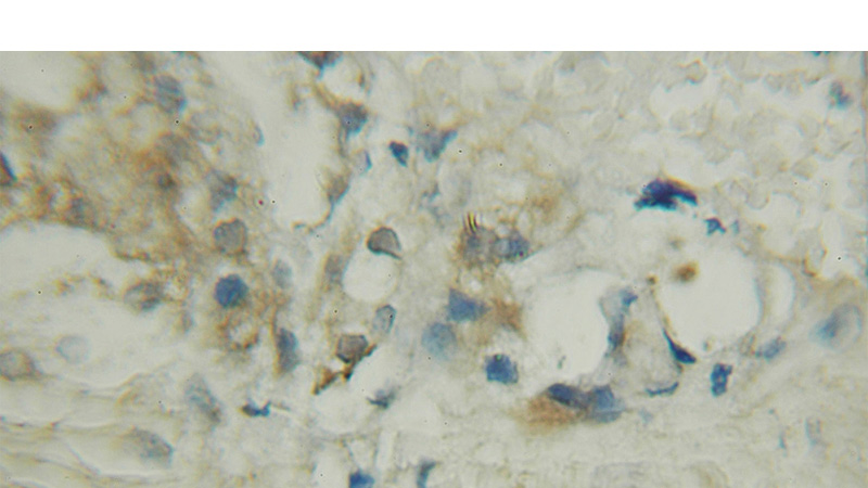 Immunohistochemical of paraffin-embedded human prostate cancer using Catalog No:111026(QARS antibody) at dilution of 1:50 (under 10x lens)