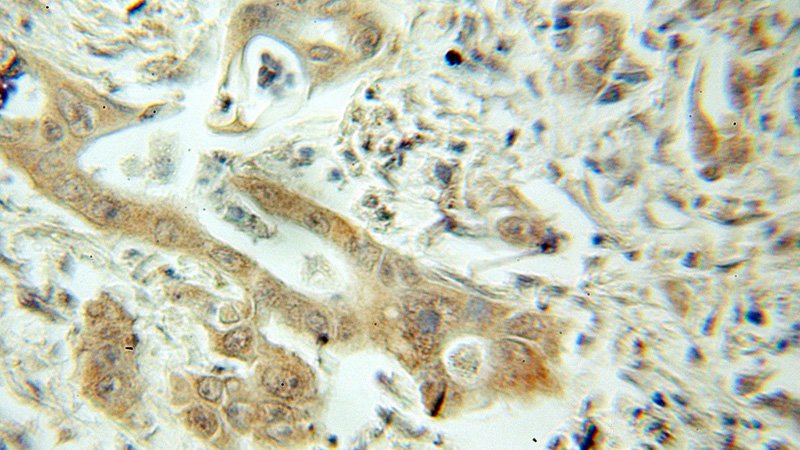 Immunohistochemical of paraffin-embedded human pancreas cancer using Catalog No:111254(USH1C antibody) at dilution of 1:50 (under 10x lens)