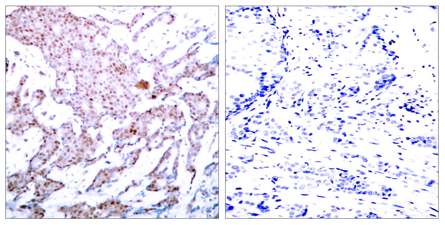 Immunohistochemical analysis of paraffin-embedded human breast carcinoma tissue using NF-κB p65 (Phospho-Ser536) Antibody  (left) or the same antibody preincubated with blocking peptide #51014 (right).