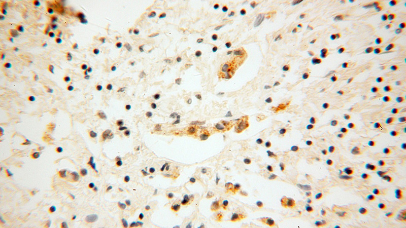 Immunohistochemical of paraffin-embedded human breast cancer using Catalog No:109949(DNAJC4 antibody) at dilution of 1:100 (under 40x lens)