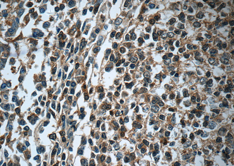 Immunohistochemistry of paraffin-embedded human tonsillitis tissue slide using Catalog No:110988(GNAI2 Antibody) at dilution of 1:50 (under 40x lens)