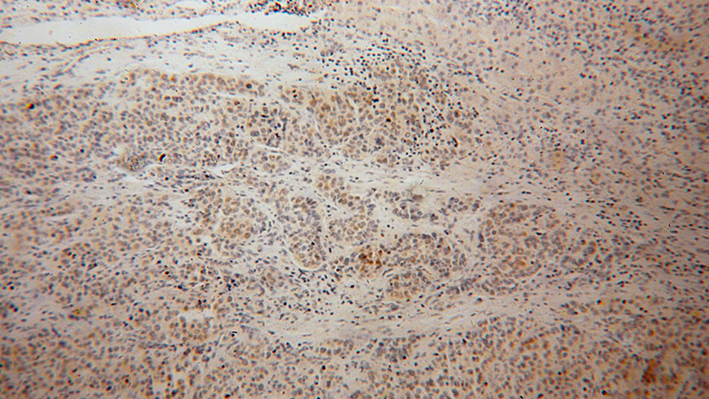 Immunohistochemical of paraffin-embedded human liver cancer using Catalog No:114001(POLE3 antibody) at dilution of 1:100 (under 10x lens)