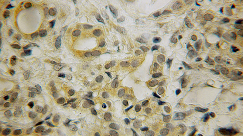 Immunohistochemical of paraffin-embedded human pancreas cancer using Catalog No:111274(HBS1L antibody) at dilution of 1:50 (under 25x lens)
