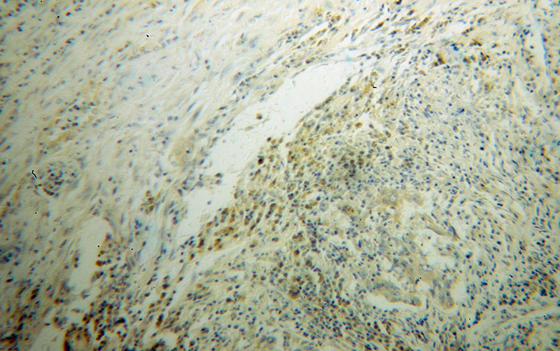 Immunohistochemical of paraffin-embedded human lung cancer using Catalog No:115230(SIK1 antibody) at dilution of 1:100 (under 10x lens)