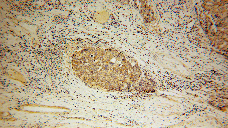 Immunohistochemical of paraffin-embedded human ovary tumor using Catalog No:109476(CORO2B antibody) at dilution of 1:100 (under 10x lens)