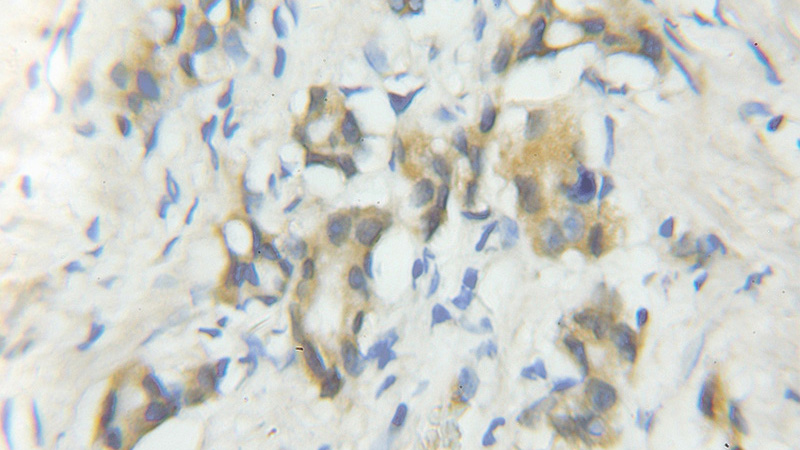 Immunohistochemical of paraffin-embedded human prostate cancer using Catalog No:108831(CALN1 antibody) at dilution of 1:100 (under 10x lens)