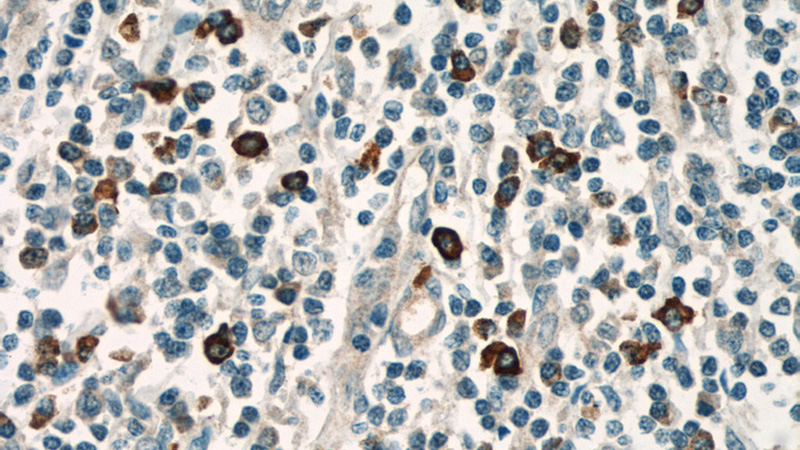 Immunohistochemical of paraffin-embedded human tonsillitis using Catalog No:111428(HLA-DRB5 antibody) at dilution of 1:50 (under 40x lens)