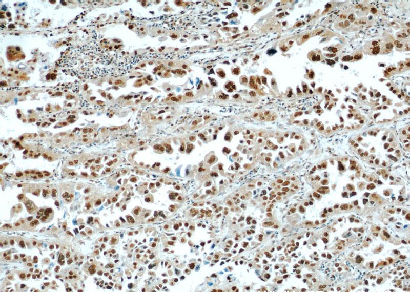 Immunohistochemical of paraffin-embedded human lung cancer using Catalog No:111386(HDGF antibody) at dilution of 1:100 (under 10x lens)