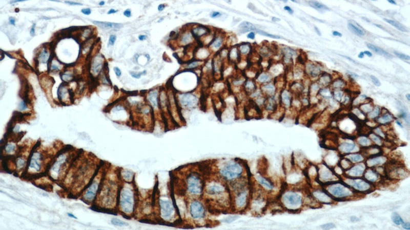 Immunohistochemical of paraffin-embedded human pancreas cancer using Catalog No:116276(TMPRSS4 antibody) at dilution of 1:50 (under 40x lens)