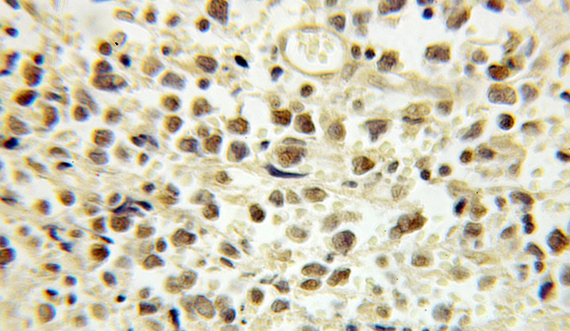 Immunohistochemical of paraffin-embedded human lymphoma using Catalog No:110155(E2F4 antibody) at dilution of 1:100 (under 10x lens)