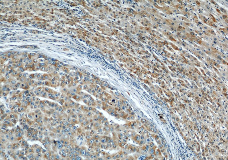 Immunohistochemical of paraffin-embedded human liver cancer using Catalog No:114216(PHB antibody) at dilution of 1:50 (under 10x lens)