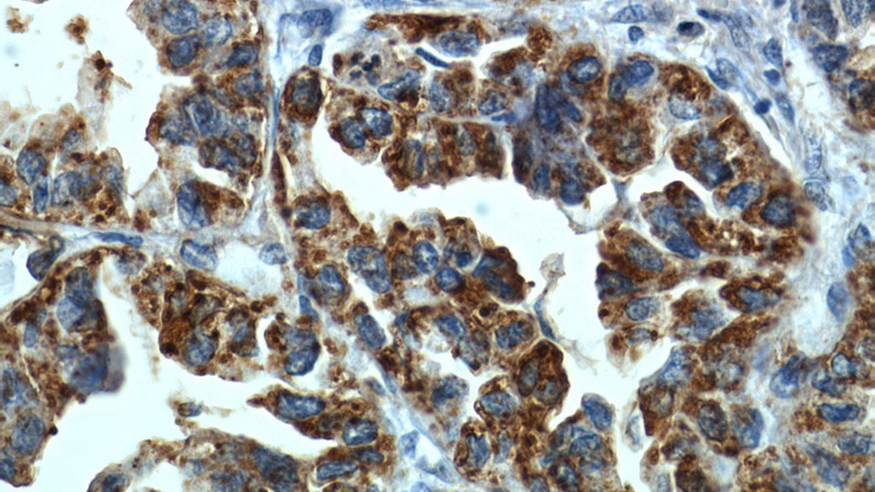 Immunohistochemistry of paraffin-embedded human lung cancer slide using Catalog No:112908(MX1 Antibody) at dilution of 1:50