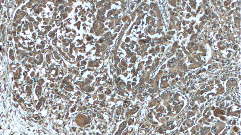 Immunohistochemistry of paraffin-embedded human liver cancer tissue slide using Catalog No:110769(GAB3-Specific Antibody) at dilution of 1:200 (under 10x lens).