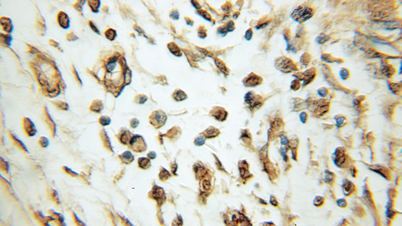 Immunohistochemical of paraffin-embedded human pancreas cancer using Catalog No:113252(NMNAT1 antibody) at dilution of 1:50 (under 10x lens)