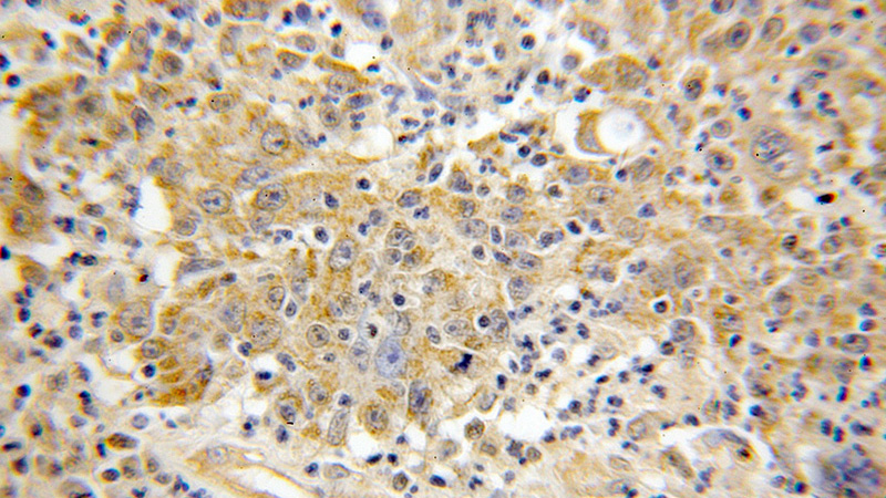 Immunohistochemical of paraffin-embedded human colon cancer using Catalog No:112778(MTHFD2 antibody) at dilution of 1:50 (under 10x lens)