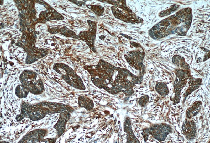 Immunohistochemistry of paraffin-embedded human skin cancer tissue slide using Catalog No:112702(MMP21 Antibody) at dilution of 1:50 (under 10x lens)