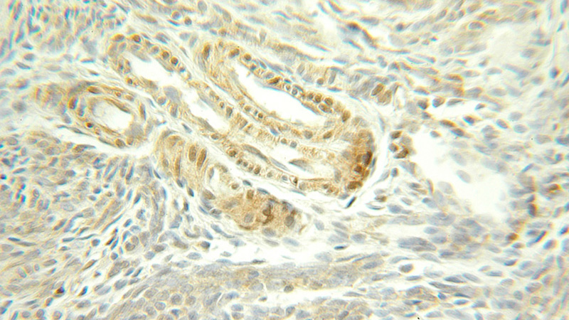 Immunohistochemical of paraffin-embedded human ovary tumor using Catalog No:111472(HSPA8 antibody) at dilution of 1:100 (under 25x lens)
