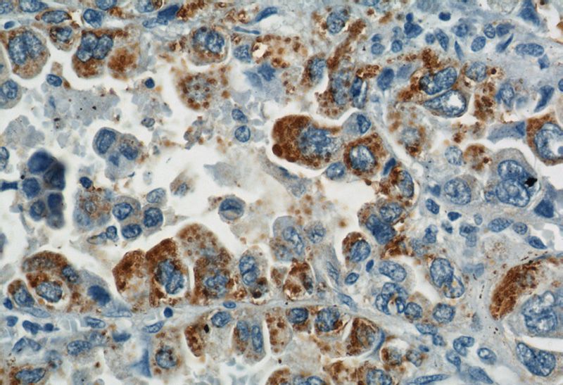 Immunohistochemical of paraffin-embedded human lung cancer using Catalog No:112277(LAMP2 antibody) at dilution of 1:50 (under 40x lens)