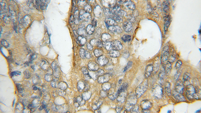 Immunohistochemical of paraffin-embedded human colon cancer using Catalog No:109084(CCT5 antibody) at dilution of 1:100 (under 10x lens)
