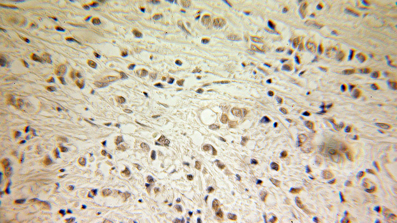 Immunohistochemical of paraffin-embedded human breast cancer using Catalog No:111478(HMGB1 antibody) at dilution of 1:100 (under 10x lens)