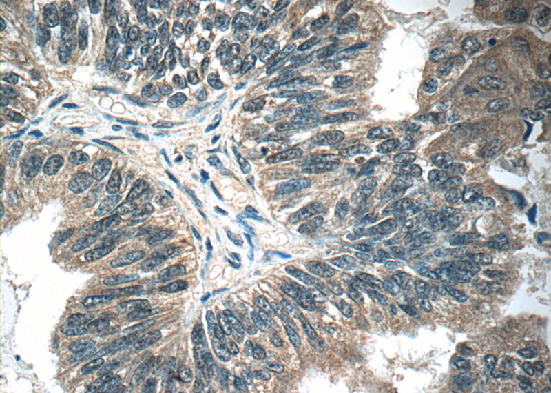 Immunohistochemistry of paraffin-embedded human ovary tumor tissue slide using Catalog No:113517(OTUD6B Antibody) at dilution of 1:50 (under 40x lens)