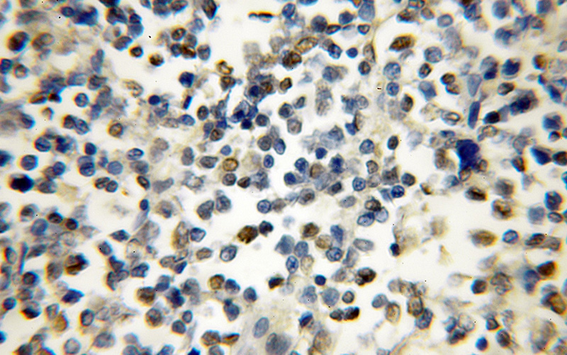 Immunohistochemical of paraffin-embedded human lymphoma using Catalog No:111647(IKZF1 antibody) at dilution of 1:50 (under 10x lens)