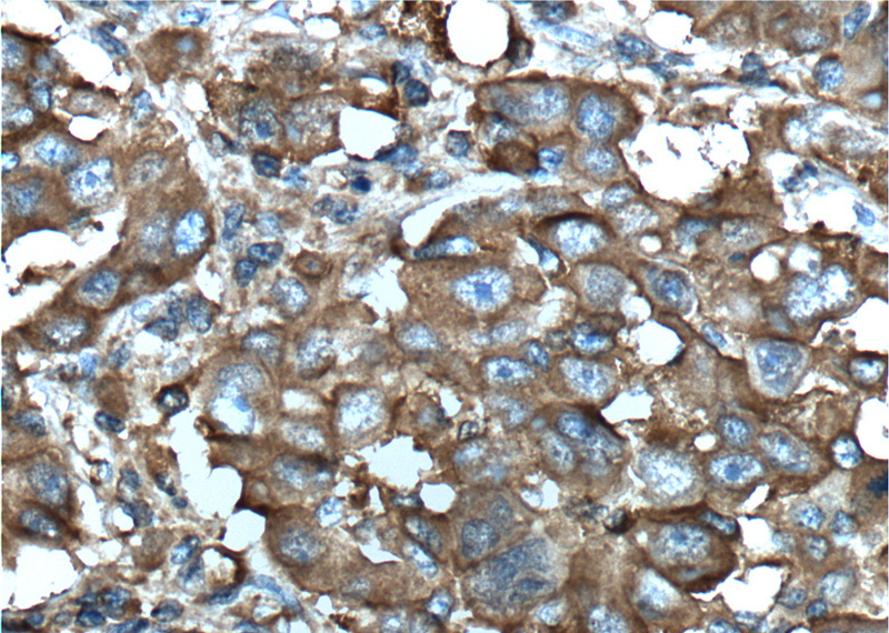 Immunohistochemistry of paraffin-embedded human liver cancer tissue slide using Catalog No:107571(ALDoc Antibody) at dilution of 1:200 (under 40x lens). heat mediated antigen retrieved with Tris-EDTA buffer(pH9).