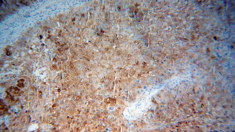 Immunohistochemical of paraffin-embedded human skin cancer using Catalog No:108828(CALML5 antibody) at dilution of 1:500 (under 10x lens)