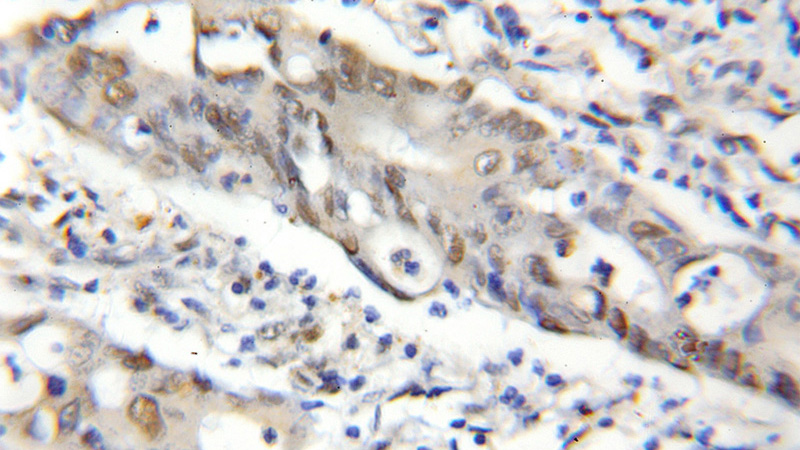 Immunohistochemical of paraffin-embedded human colon cancer using Catalog No:112657(MEPCE antibody) at dilution of 1:50 (under 10x lens)