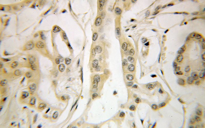 Immunohistochemical of paraffin-embedded human pancreas cancer using Catalog No:110482(ETF1 antibody) at dilution of 1:100 (under 40x lens)