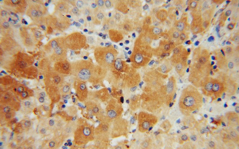 Immunohistochemical of paraffin-embedded human liver cancer using Catalog No:107785(ADSL antibody) at dilution of 1:50 (under 40x lens)