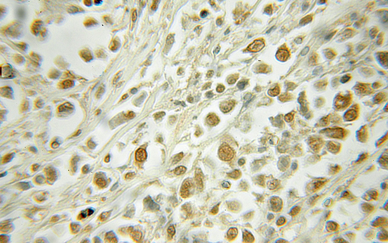 Immunohistochemical of paraffin-embedded human lymphoma using Catalog No:114513(RAD23A antibody) at dilution of 1:50 (under 10x lens)