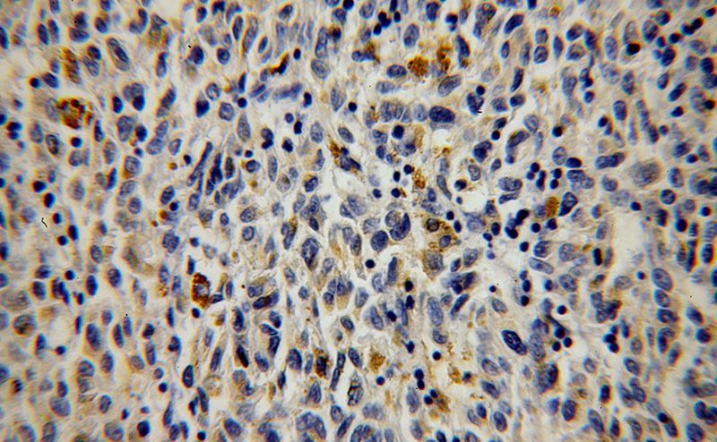 Immunohistochemical of paraffin-embedded human malignant melanoma using Catalog No:115965(MAP3K7IP2 antibody) at dilution of 1:100 (under 40x lens)