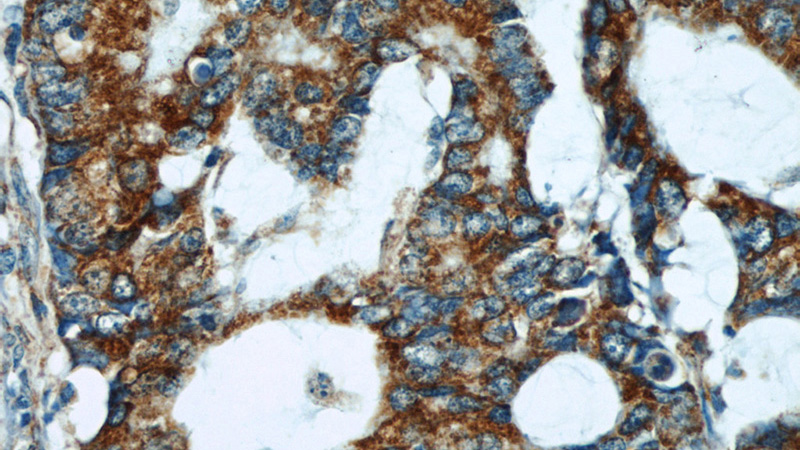 Immunohistochemical of paraffin-embedded human colon cancer using Catalog No:109785(CYCS antibody) at dilution of 1:50 (under 40x lens)